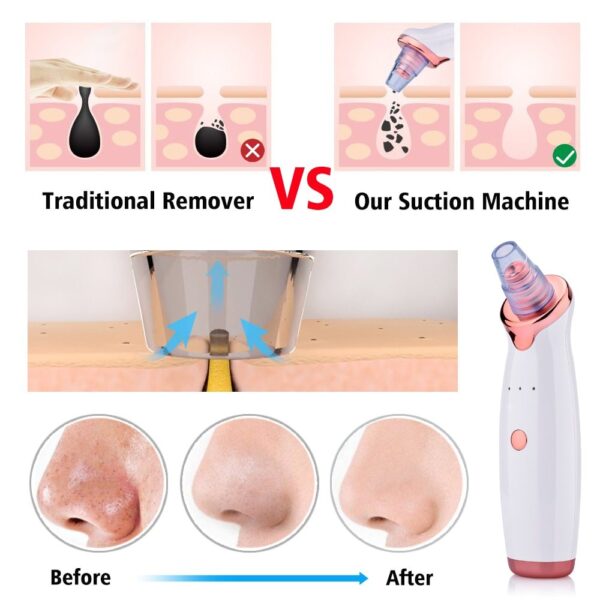 Ultimate 5-Level Electric Blackhead Remover – Powerful Pore Vacuum Acne & Facial Cleaner